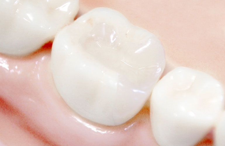 仮歯での形態・機能の評価