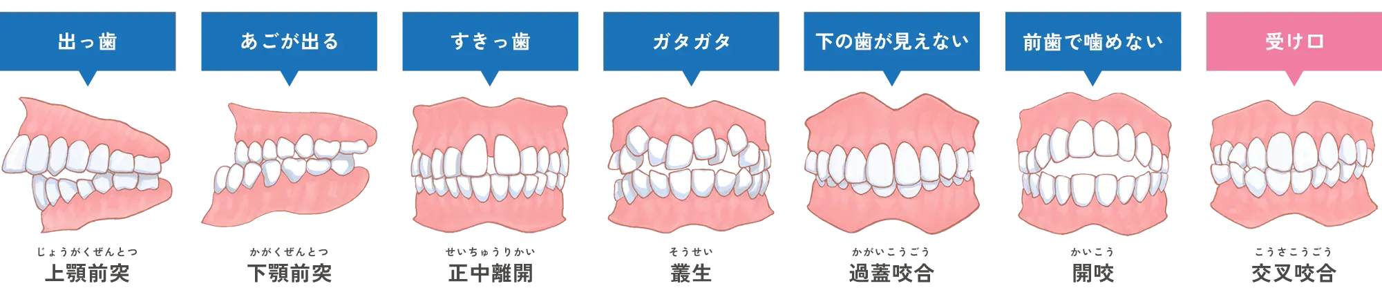 歯ならびの種類