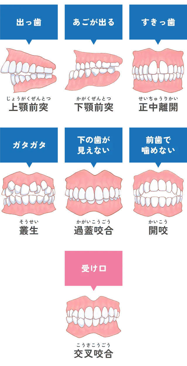 歯ならびの種類