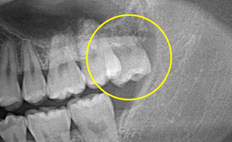 CASE4：親知らずの抜歯