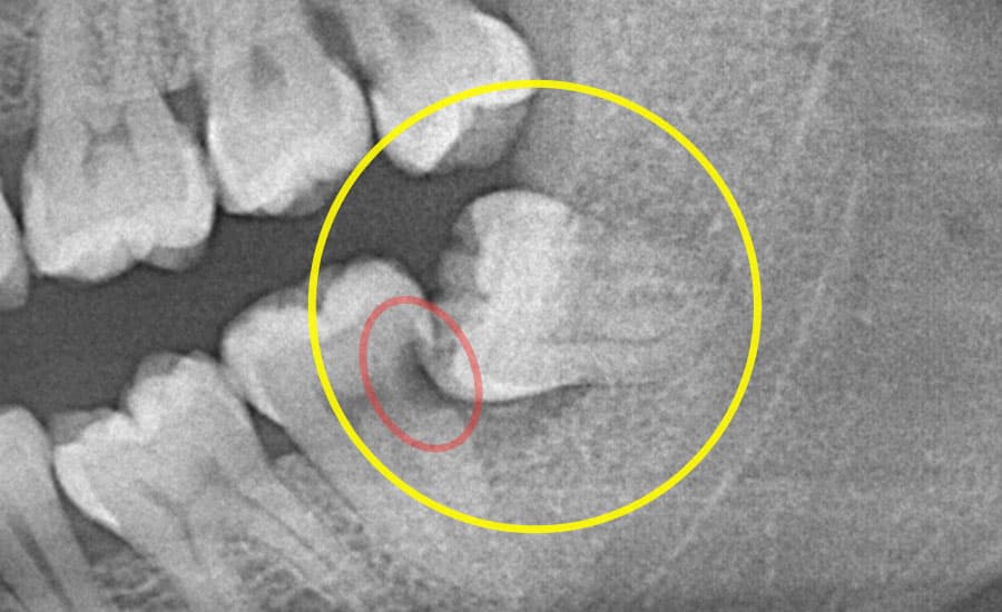 CASE2：親知らずの抜歯