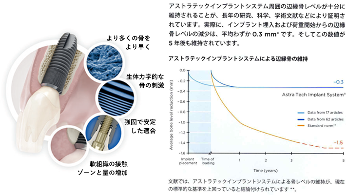 アストラテックインプラントシステム